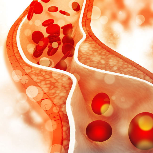 cholesterol plaque in the artery