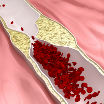 peripheral artery disease