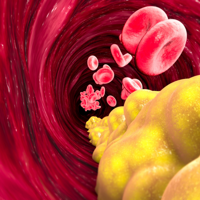 cholesterol in the artery