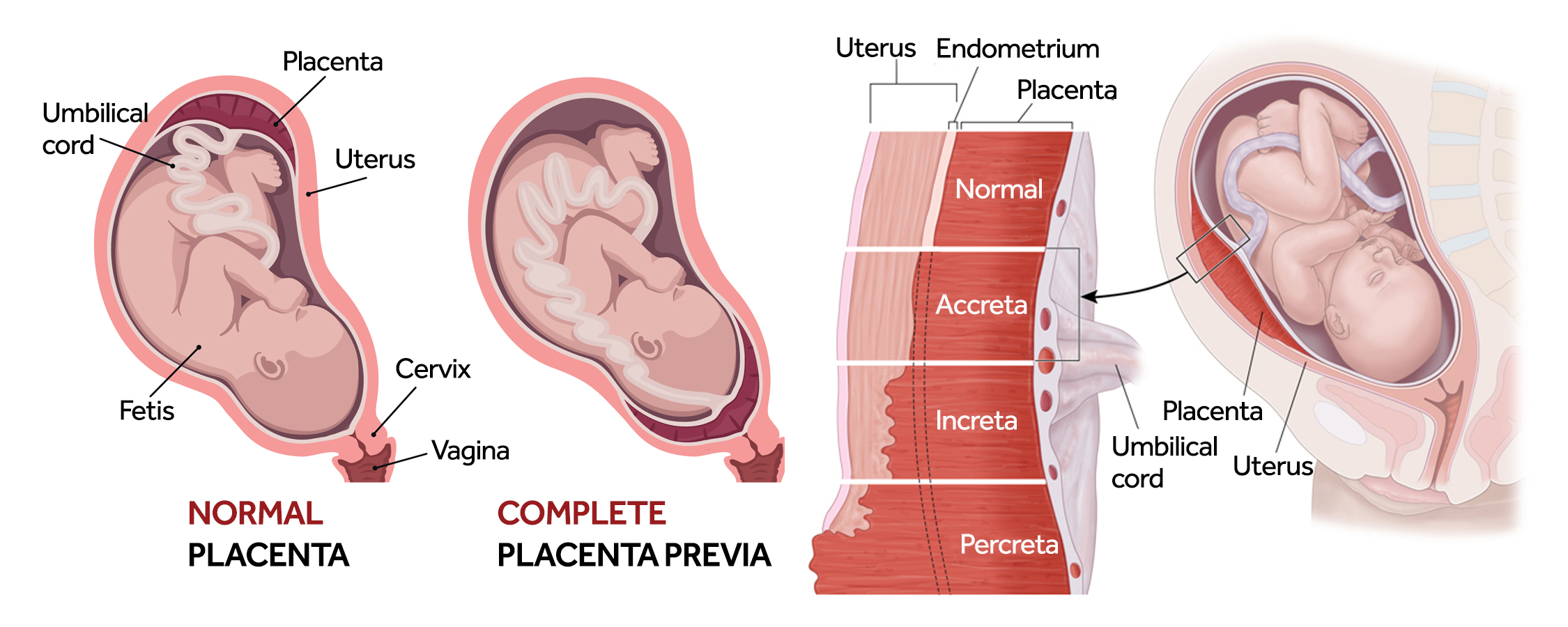 Accreta 