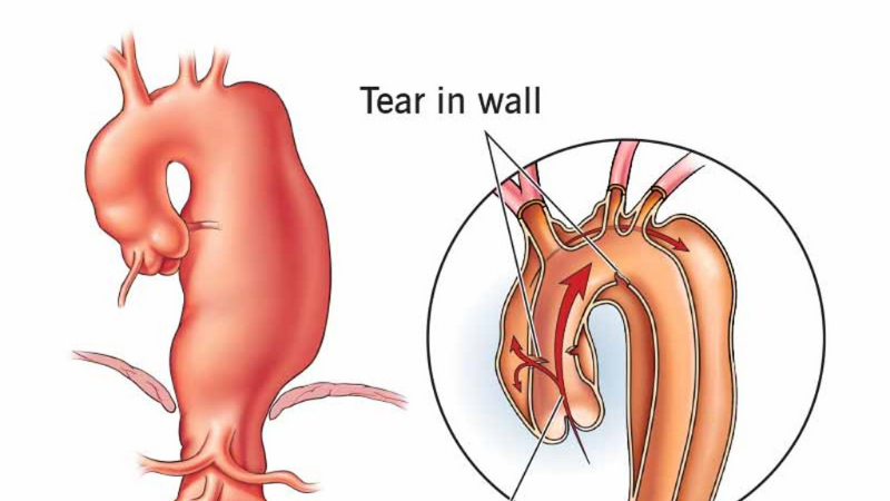 Aortic Dissection Illustration