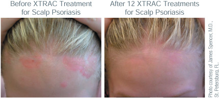 Scalp Psoriasis