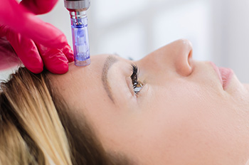 Microneedling or Fractional Dermal Needling