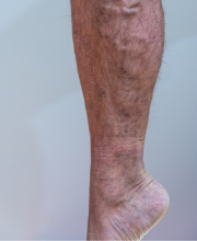 Varicose Veins