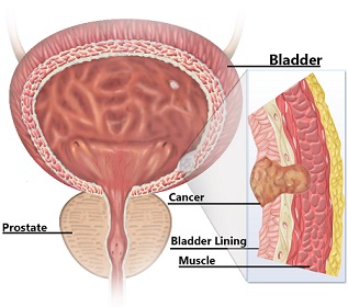 Diagram showing Bladder Cancer