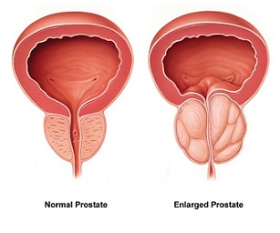 Medical abbreviation bph Enlarged Prostate