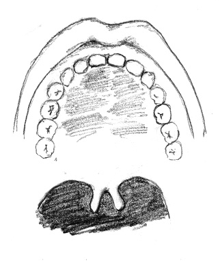 Fisura submucosa con la úvula bífida