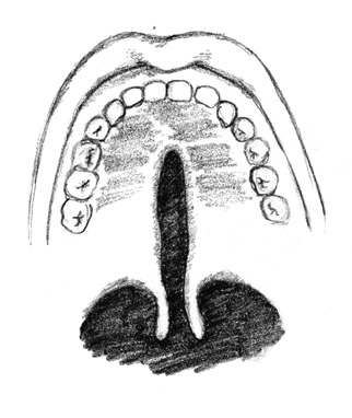 Fisura submucosa con la úvula bífida