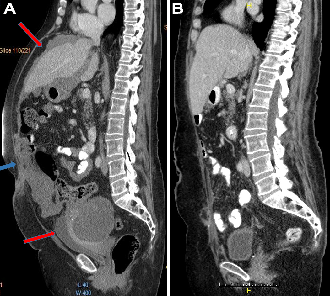 CT scan images show the changes in abdominal distension before (A) and after (B) cytoreduction and HIPEC. an image is here