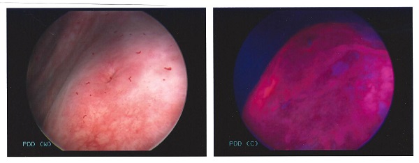 cistoscopia