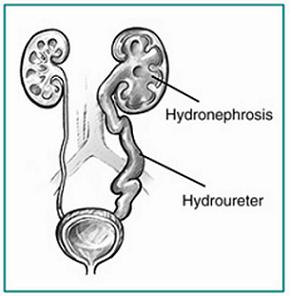 Hidronefrosis