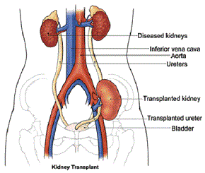transplante de riñón
