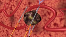 IRE kills tumor cells without causing collateral damage to adjacent tissue