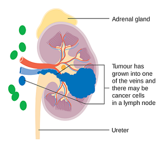 Diagram showing cancer in the kidney