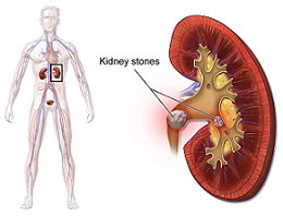 Kidney Stone