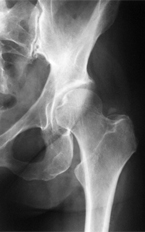 hip fracture hip fracture