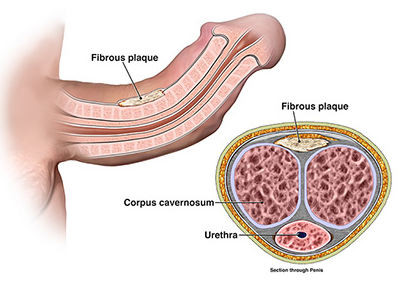 Peyronie's