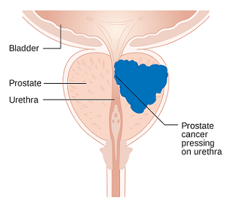 el cáncer de próstata