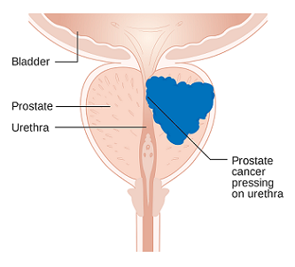 Diagram of Prostate Cancer 