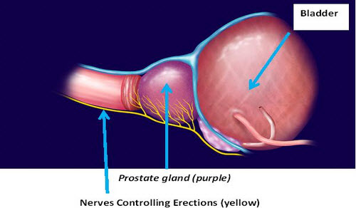 mønster Til fods millimeter Robotic Prostatectomy | Stony Brook Medicine