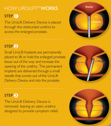 Urolift diagram