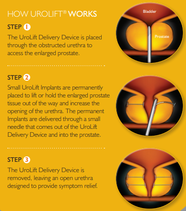 Diagrama de Urolift