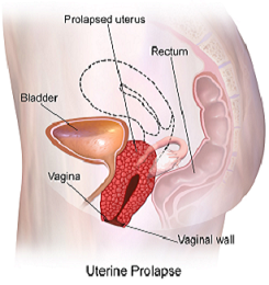 Prolaps