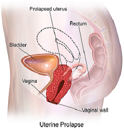 Diagram showing prolapse of the uterus 