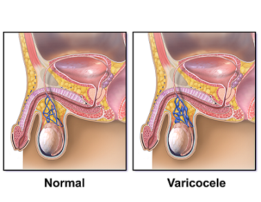 varicozèl