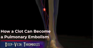 How a Clot Can Become a Pulmonary Embolism